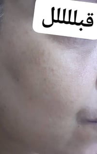 بكج بشرة • كريم دلوش • ابرة العنبر