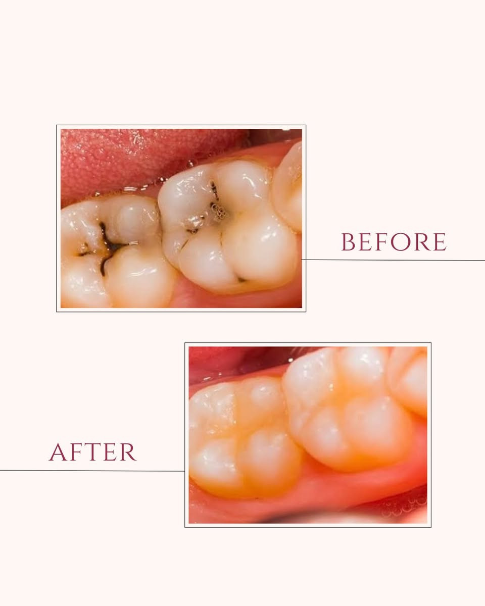 🌙✨ عروض آخر أسبوع من رمضان – مجمع السيف الطبي لطب الأسنان ✨🌙

قبل العيد… اعتنِ بابتسامتك واستفد من عروضنا الخاصة:

🦷 خصومات على حشوات الأسنان  
🦷 خصومات على حشوات الجذور (سحب العصب)  
🦷 خصومات على قلع الأسنان

🎁 عرض خاص: تنظيف أسنان مجاناً مع كل حشوة  
🔎 معاينة مجانية طوال هذا الأسبوع

👨‍⚕️ بإشراف: الدكتور علي سالم جمعة

📍 الموقع: بغداد – الكميرة قرب جامع أبو الزهراء  
🗓 أيام الدوام: السبت – الاثنين – الأربعاء  
📞 للتواصل والاستفسار والحجز: ***********

✨ ابتسامتك تهمنا…
نموذج عن الشغل
