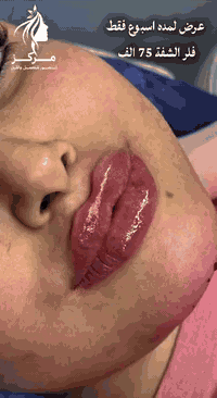 فيلر شفايف • د. مروه العامري • المنصور الداودي