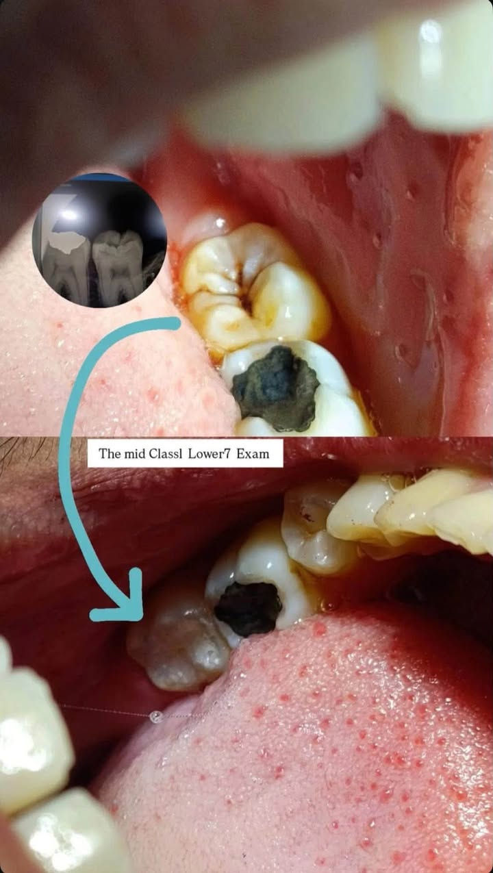 �🔶🔶 مجاناً 🔶🔶🔶
ببركة الله، نعلن عن تقديم خدمات علاج الأسنان مجاناً

ابتداءً من 22 محرم ولغاية 22 صفر.

ايام العمل: الاثنين/ الثلاثاء/ الأربعاء 

🦷 الخدمات تشمل:

• تنظيف الأسنان

• الحشوات

• القلع

📲 للحجز والاستفسار، يرجى مراسلتنا على الواتساب:

***********

كربلاء ♦️
