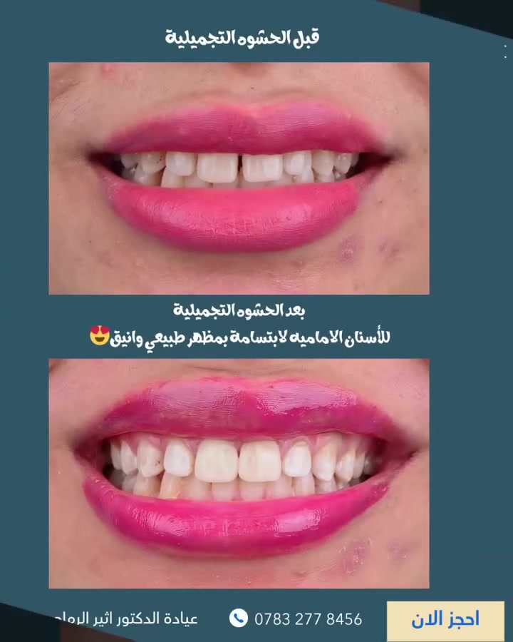 استعادة جمال الأسنان الأمامية بحشوات تجميلية
 تمنح ابتسامة أكثر إشراقًا وثقة. ✨

(عيادة الدكتور أثير حليم الرماحي) 

☎️ للحجز والاستفسار ***********
او مراسلة الصفحة

 
📍 الموقع: 
الديوانية- قضاء عفك/شارع الأطباء قرب صيدلية أكرم البديري بناية الدكتورة مروة حمود التميمي الطابق الثاني

#ابتسامتك_تستحق_الأفضل
#دكتور_أسنان#حشوات_تجميلية_للأسنان🦷
#اكسبلورexplore #الديوانية_عفج
