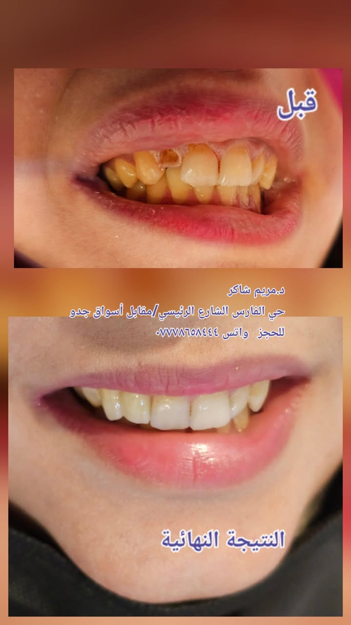 عمل حشوات الجذور للاسنان وبناء الاسنان وتغليفها بتركيبات الزاركون الثابتة وتعويض الاسنان المفقودة 
حي الفارس الشارع الرئيسي قرب محطة وقود الفارس 
د.مريم شاكر 
للحجز واتس ***********
يتوفر خصم ٤٠ بالمية 
يتوفر خصومات للعوائل ذات الدخل المحدود #قلع #حشوات#حشوات جذور #تركيبات ثابتة ومتحركة #زراعة اسنان #تقويم اسنان
