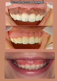 توريد اللثة • مجاناً • عيادات جامعة الكنوز