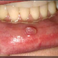 ، اذا احد عنده هيج حالات بالفم ف يتواصل وياي ، واي شي يشوفه مو طبيعي د...