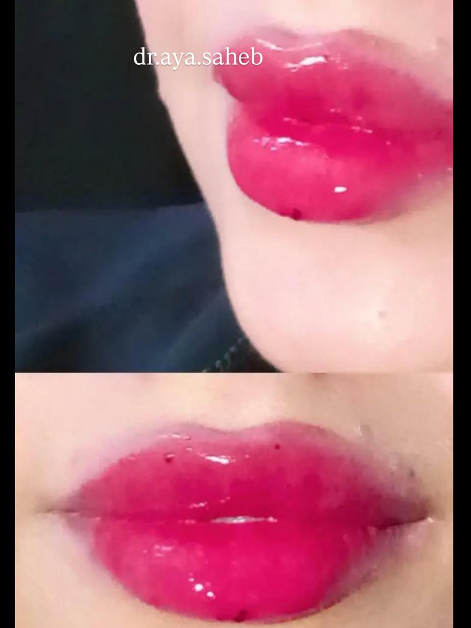 مجموعة صور مختلفة من مراجعاتي بعد حقن فلر الشفة ♥️ صورة احلى من صورة 🍬😍
للحجز والاستفسار/***********
الديوانية 📍
