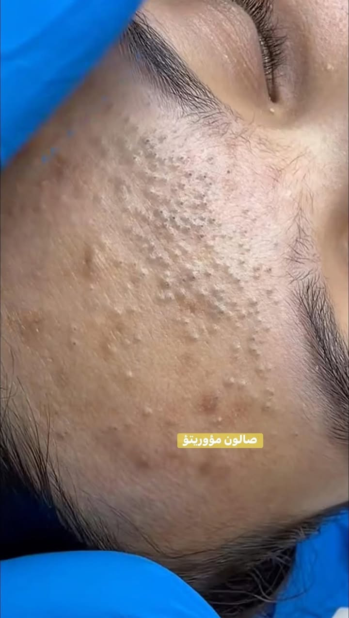 لاتخلي. بشرتك حقل تجارب 🧏🏿🧏🏻
اقوى واحدث الجلسات العالميه 🌍
ازاله الرؤؤس السوداء ومعالجتها ☑️
ازاله الدهون.   وتقليص المسام 👨🏻‍⚕️

للحجز مرسله الحساب اوالاتصال 
***********📞
العنوان. ناصريه قضاء النصر. خلف مستوصف الزهراء
