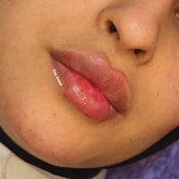 فيلر الشفه • جلدية وتجميل • بسمايه اكرم تسوق