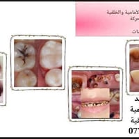 وياكم الدكتورة شهد عامر  الي محتاج حشوه ضوئيه للاسنان الامامية وخلفية ...
