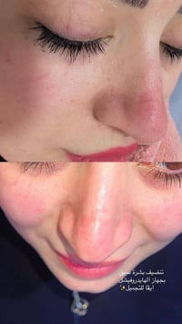 تنظيف بشرة عميق • الهايدروفيشل • كوت زويريجات