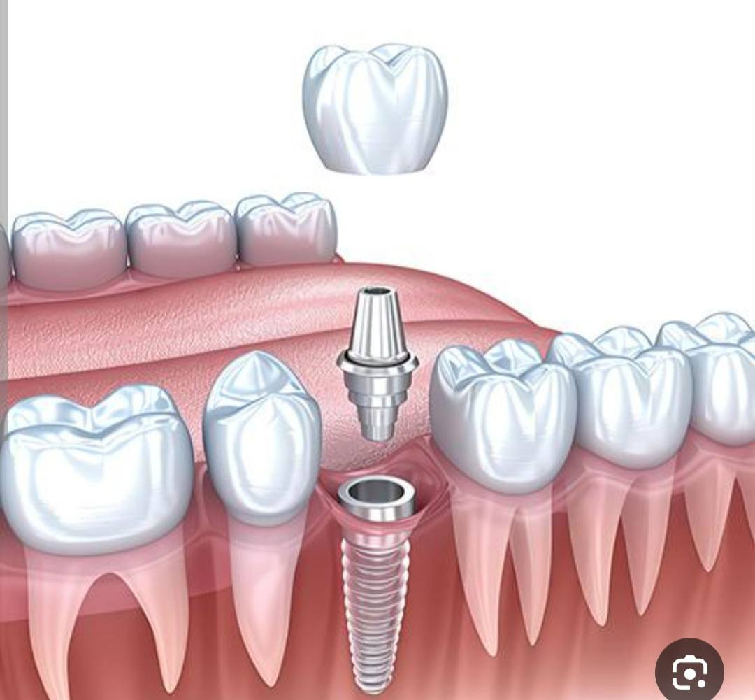 السلام عليكم
أنا طالب ماجستير في جراحة الفم  - كلية طب الأسنان 
   

يقدم فرع جراحة الفم والفكين بالكلية الخدمات الآتية 

قلع الأسنان وأضراس العقل المنطمرة  جراحيا 
زراعة الأسنان  
و متابعة أي حالة مرضية بالفم والفكين  وإزالتها جراحيا 

من لدية الحالات المذكورة   التفضل بالتواصل على الرقم 
***********     (واتساب)

تقدم الخدمات بأسعار رمزية

