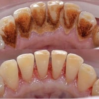 مجانا • تنظيف أسنان • حي النقيب