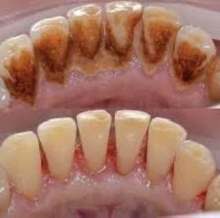 السلام عليكم
تنويه 🔔
يتوفر لدينا تنظيف اسنان وقلع وحشوات تحت إشراف أطباء اختصاص في جامعة العميد 
علماً إن العمل مجاني 🚨
للأستفسار اكثر التواصل مع الصفحه او الاتصال بالرقم ***********
