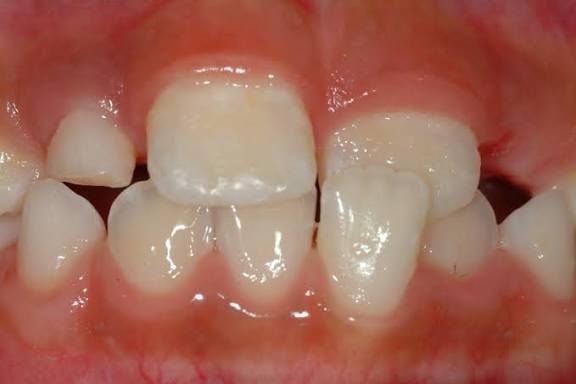 السلام عليكم 
الي محتاج علاج تقويم مثل هل حالات  بلصور لعمر 15 واقل مجانا يراسل علرقم ***********
من شهر الثاني نبلش فراح اثبت فقط لطفل واحد الي يريد يراسل
