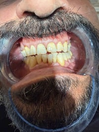 الي عنده تكلسات نفس الصوره ⬇️ يتواصل وياي باجر عياده تنظيف اسنان مجاني...