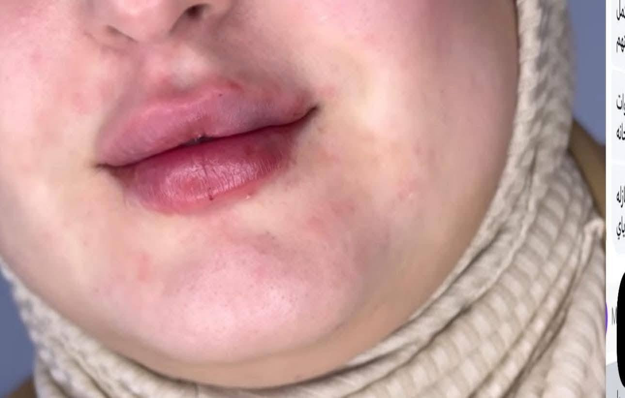 ✨ عروض لفترة محدودة | صالون الروان ✨
​دللي نفسكِ مع خبيرة التجميل الدكتورة انتصار
​نقدم لكِ أرقى الخدمات التجميلية بأحدث التقنيات لضمان إطلالة ساحرة وثقة لا حدود لها. استغلي الفرصة الآن قبل انتهاء مدة العرض!
​💄 أبرز خدمات قسم التجميل (بإشراف د. انتصار):
​علاجات البشرة: تنظيف بشرة عميق، هيدرافيشل، ونضارة فورية.
​الرتوش التجميلية: فيلر، بوتوكس، ورفع الحواجب.
​العناية المتقدمة: جلسات الميزوثيرابي والبلازما للشعر والبشرة.
​اللمسات النهائية: مكياج سينمائي ومكياج عرائس احترافي.
​📅 لماذا تختارين الدكتورة انتصار؟
​"الدقة في التنفيذ واللمسة الفنية التي تبرز جمالكِ الطبيعي هي شعارنا في قسم التجميل." العنوان كربلاء قنطرة السلام
***********
