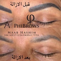 ازالة تاتو • في ريموفل • المحمودية الرشيد