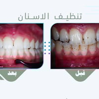 خصم 50% على تنظيف الاسنان للحجز والاستفسار رقم الحجز 07721257334