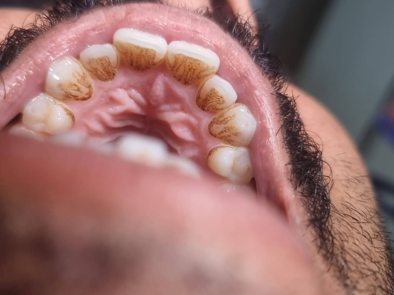 من الاعمال اليوميه لعيادتنا
#عيادة_كوثى_لطب_وتجميل_الاسنان 

تنظيف الاسنان لاحد مراجعينا💫
التخلص من التصبغات الجيريه على طبقة المينا
ومنضر الاسنان 
ليتحول  منظر الاسنان الى لامع ناصع البياض
#الدكتور_علي_حسن_العزاوي

يتوفر العمل بالتقسيط المريح على زراعة وتغليف الاسنان

بابل/جبله/نهاية شارع الاطباء (مقابل مجمع الدكتوره ميثاق المعموري )
للاستفسار
***********
