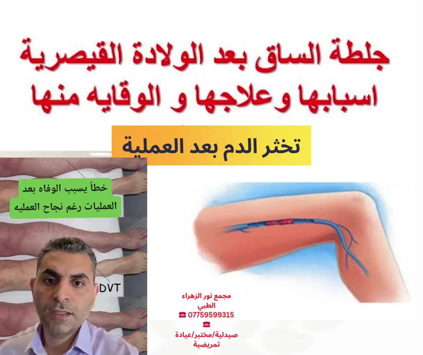 ❤جلطة الساق بعد الولادة القيصرية!!!
👩‍⚕️
صيدلية نور عبدالله الزلزلي
🔹️علما انه يوجد في المجمع🏨
️🧑‍🔬مختبر الدر للتحليلات المرضية والهرمونات👨🏼‍🔬
️🧑‍⚕️عيادة تمريضية لزرق الإبر وتداوي الجروح🧑🏼‍⚕️
                                       ➖️➖️➖️
#العنوان
📍-بغداد -المشتل - منتصف شارع المطبك - مقابل مصور طرابلس -مجاور صيدلية نور عبد الله الزلزلي 📍
                                      ➖️➖️➖️
للحجز والاستفسار يمكن الاتصال على الرقم
☎️ *********** 
#جلطة_الساق#الولادة_القيصرية
@متابعين@أبرز المعجبينالجميعيالكل
