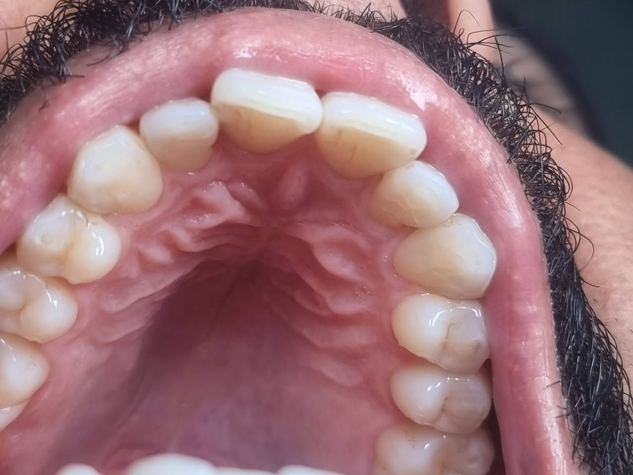 من الاعمال اليوميه لعيادتنا
#عيادة_كوثى_لطب_وتجميل_الاسنان 

تنظيف الاسنان لاحد مراجعينا💫
التخلص من التصبغات الجيريه على طبقة المينا
ومنضر الاسنان 
ليتحول  منظر الاسنان الى لامع ناصع البياض
#الدكتور_علي_حسن_العزاوي

يتوفر العمل بالتقسيط المريح على زراعة وتغليف الاسنان

بابل/جبله/نهاية شارع الاطباء (مقابل مجمع الدكتوره ميثاق المعموري )
للاستفسار
***********
