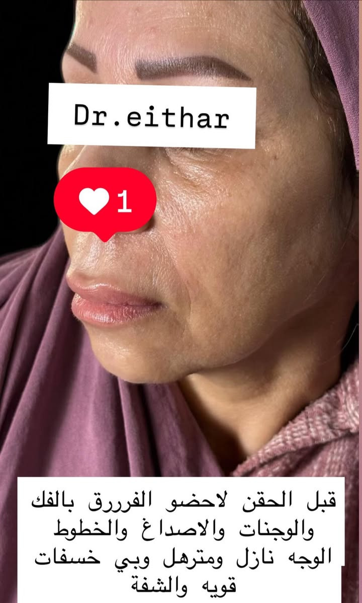 التغيير والشد والشفة ولاغلطة 🔥🔥🔥
استداره وجه كامله بطريقه الشد ولفتتك 🔥رفع وجنات والاصداغ وتدوير الفك والذقن✨وفلر  الشفة

بلشت عروووووض عيد الحب نزلتهه الكم بالستوري بالهايلايت وببوست اعلى الصفحة تبلش من باجر الخميس ✨
 
د.ايثار سامي عبد الامير
الكوت الهوره مجمع القبطان طابق اول قرب كوزمتك احمد باريس
الحجز***********
