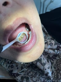 حشوات ضوئية مجانية • أسنان أمامية • تنظيف تكلسات