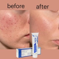 كريم ديفرين • علاج حب الشباب • مقشر للكلف