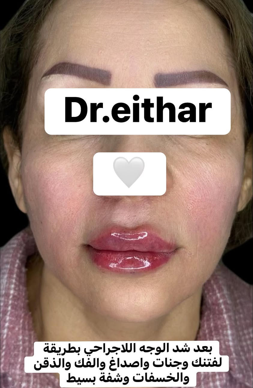 التغيير والشد والشفة ولاغلطة 🔥🔥🔥
استداره وجه كامله بطريقه الشد ولفتتك 🔥رفع وجنات والاصداغ وتدوير الفك والذقن✨وفلر  الشفة

بلشت عروووووض عيد الحب نزلتهه الكم بالستوري بالهايلايت وببوست اعلى الصفحة تبلش من باجر الخميس ✨
 
د.ايثار سامي عبد الامير
الكوت الهوره مجمع القبطان طابق اول قرب كوزمتك احمد باريس
الحجز***********
