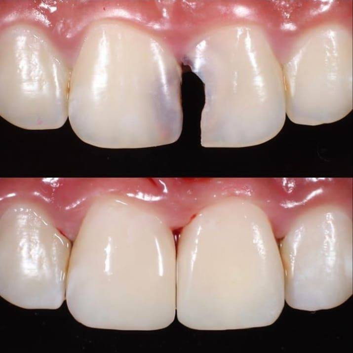 علاج مجاني لعدد محدود جدا 
حشوات تجميلية للاسنان 
عنوان / كربلاء ـ الحر 
للحجز والاستفسار راسلونا على الخاص 
او واتساب / ***********
