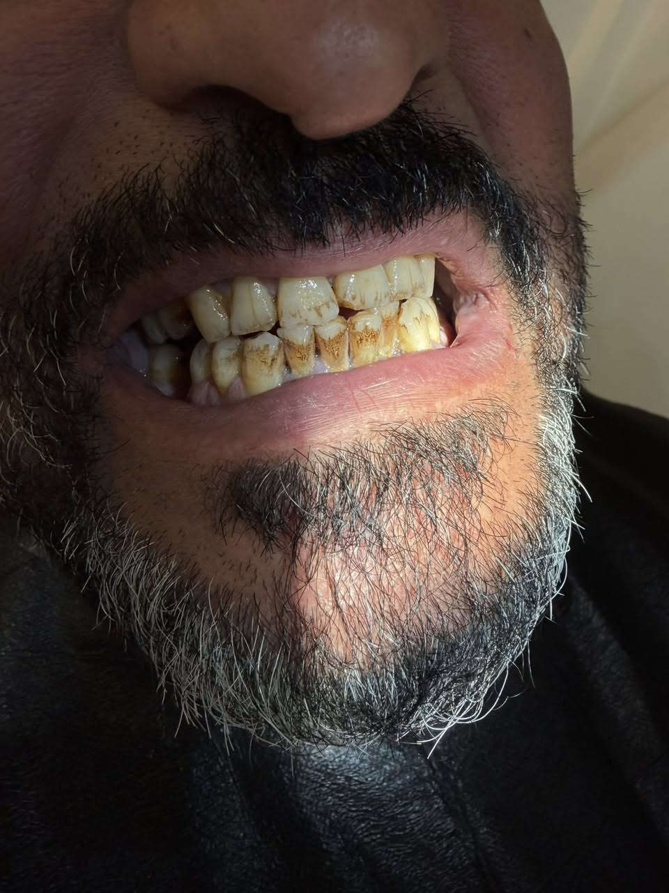 السلام عليكم
الي عنده تكلسات نفس الصوره ⬇️
يتواصل وياي باجر عياده تنظيف اسنان مجانيه 
للحجز 
***********واتساب
