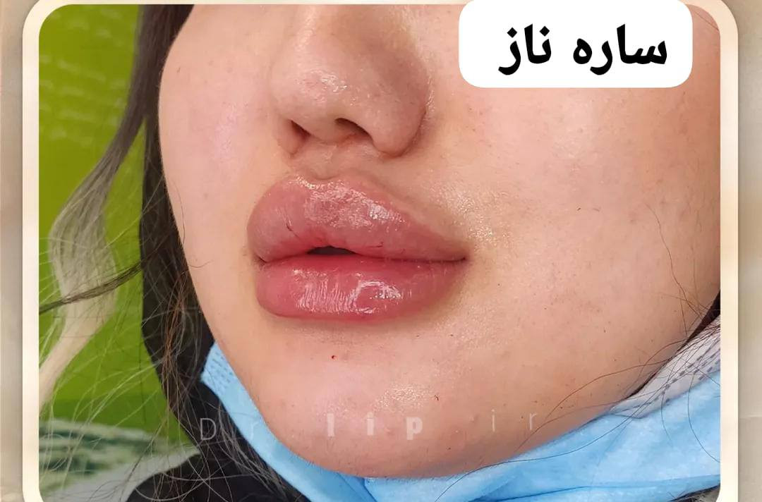 السلام عليكم  حبايب عروض،شهر رمضان الكريم  فلر السويسري لشفه  40 الف  والكوري 35 الف   والفرنسي  60 الف. 💋💋تغيير شامل بلكوري 175 الف. تغيير شامل بلسويسري 225 الف. تغير شامل بلفرنسي 300 الف . الشامل يشمل وجنات خدود ذقن اصداغ شفه sواحد 
 مكان بغداد الجديده نعيريه قرب فلكه رقم عشره


**إذا كنت صاحب هذا الإعلان وتريد حذفه لأي سبب، رجاءا أرسل رسالة إلى الدعم الفني**