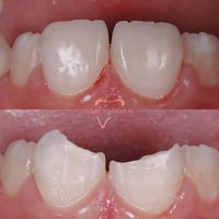 سلام عليكُم اذا عدكم هيج كسر بأسنانكم وتريدون تسوونة  مجاني وشغل حلو ب...