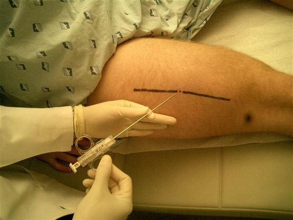 📣لاول مره في مدينة تلعفر  وغرب نينوى 📣
 

نعلن عن توفير خدمة أخذ خزعة الـ Tru-Cut
في مختبر غرب نينوى التخصصي

 💉 شنو هي إبرة الـ Tru-Cut؟

إبرة Tru-Cut هي أداة طبية خاصة تُستخدم لأخذ خزعة نسيجية (Core Biopsy) من أي كتلة داخل الجسم، حتى نقدر نفحصها 
تحت المجهر ونعرف طبيعتها بدقة.

🪬شنو تفرق عن الإبرة الرفيعة (FNA)؟
 • FNA تأخذ خلايا فقط.
 • أما Tru-Cut تأخذ قطعة نسيج كاملة فيها خلايا + ستروما + ترتيب نسيجي.
وهذا يخلي التشخيص أوضح خصوصًا بحالات الأورام.

شنو أهمية خزعة الـ Tru-Cut؟

1️⃣ دقة أعلى بالتشخيص

إبرة الـ Tru-Cut تأخذ عينة نسيجية كاملة (Core) مو مجرد خلايا.
وهذا يسمح للطبيب الباثولوجي يشوف:
 • ترتيب الخلايا
 • الحدود
 • طبيعة الستروما
 • وجود تليف أو غزو أو التهاب

وهذه المعلومات ما تظهر غالبًا بـ FNA.

⸻

2️⃣ تميز بين الأورام الحميدة والخبيثة بشكل أوضح

لأن العينة أكبر وتحتوي على طبقات النسيج، تكون:
 • نسبة التشخيص الدقيق أعلى
 • نسبة إعادة العينة أقل

خصوصًا في كتل الثدي والعقد اللمفاوية.

⸻

3️⃣ إجراء سريع وآمن
 • يتم تحت تخدير موضعي فقط
 • الألم بسيط جدًا
 • ما يحتاج دخول للعمليات
 • وقت الإجراء بحدود دقائق

⸻

4️⃣ مناسبة لكل الكتل تقريبًا

تُستخدم للـ:
 • الثدي
 • العقد اللمفاوية
 • الأنسجة الرخوة
 • الكبد (بحالات معينة)

وغالبًا تحت توجيه الألتراساوند لضمان الدقة.

⸻

5️⃣ تساعد على تحديد الخطة العلاجية

بما أن النتيجة تكون واضحة وغنية بالمعلومات النسيجية، فالمريض يحصل على:
 • تشخيص أدق
 • قرار علاجي أسرع
 • متابعة أفضل مع الجراح أو طبيب الاورام

مواعيد العمل:

ابتداءً من أول الأسبوع القادم ستكون الخدمة متوفرة بشكل رسمي داخل المختبر.

⸻
كادر مختبر غرب نينوى التخصصي

 👩‍⚕️ الدكتورة وجدان ناصر أحمد
أخصائية نسيج مرضي وخلوي – دكتورة بورد عربي
 👩‍⚕️ الدكتورة دنيز يلماز وهب
أخصائية نسيج مرضي وخلوي – دكتورة بورد عربي
 👨‍⚕️ الدكتور وسام عبد القادر
ماجستير كيمياء سريرية
 📃  البكتريولجية رنا ناظم محمد
 بكالوريوس أحياء مجهرية

العنوان:
تلعفر – مقابل قائمقامية تلعفر

هاتف 📞 0777 179 0777-***********
