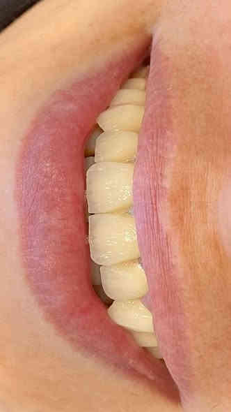 ابتسامة  ساحره وثقة مضاعفه 🩵🔥 عيادتنا فرع حي النصر 🔥🔥

تعويض الاسنان باستخدام ( اسنان الزاركون ألماني) لمراجعتنا من حي النصر 
وتم تعويضها ب اسنان 
- الزاركون  الدائمي( الألماني) 
على يد الطبيب الاختصاص
د.محمد منصور 
(ماجستير في طب ومعالجة الاسنان) 

أبتسامتك ~ يم عيادات الفرح لطب وتجميل الأسنان ~ غير ✨😍

علماً كافة الابتسامات والحشوات مع ضمان مدى الحياة 😎

للإتصال 📞📞 
فرع حي النصر

*********** ☎️

دوام العياده ⏰
فرع حي النصر 
من الساعه 5  عصرا 
إلى 
الساعه 10 مساءا
