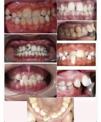 اذا عندكم اطفال اسنانهم نفس هاي الحالات الجوة تواصلو وياية 07876116029...