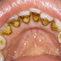 تنظيف أسنان • إزالة تكلسات • جلسة واحدة