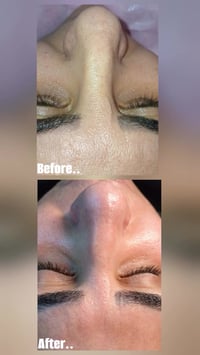 ميكرونيدلنغ • تنظيف بشرة • بسماية بلوكb1