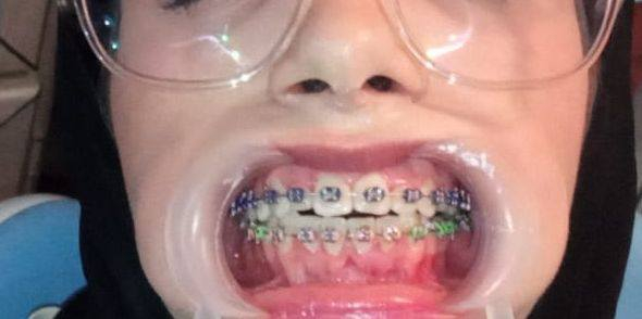 عياده الدكتور عماد عطا الله البدري
لزراعه وتقويم الاسنان رقم عياده ***********
