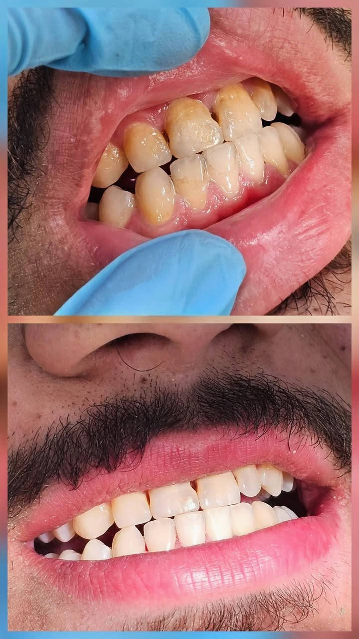 السلام عليكم
ابتداءاً من يوم الاحد راح ترجع العيادات التعليمية لجامعة الهادي تفتح
نستقبلكم من خلالها ونقدملكم علاج للاسنان من حشوات وتتظيف وقلع وتعويض بالاطقم المتحركة وهذا بعض شغلنا اني وزملائي وجميعهم جانوا راضين بالنتائج.
 للمهتمين تكدرون تتواصلون وياي ونرتب موعد سريع ومضمون ومجاني.
***********
