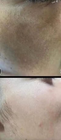 خلطة تبييض • خلال يومين • توصيل