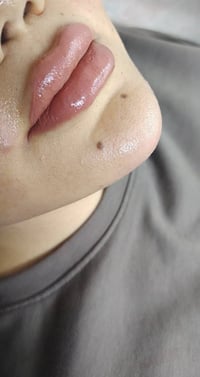 تحديد حنك • فيلر شفه