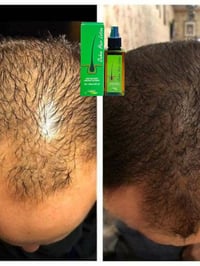 بخاخ شعر • بخاخ لملء فراغات الشعر • بخاخ لتكثيف الشعر • علاج فراغات ال...