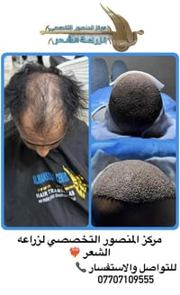 جمعه مباركـه 🩶  عندك مانحه ضعيفه وصلع واسع ومتردد من لزراعه❓ الحل يمنه...