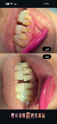 تبييض أسنان • تنظيف أسنان • عيادات جامعة أهل البيت