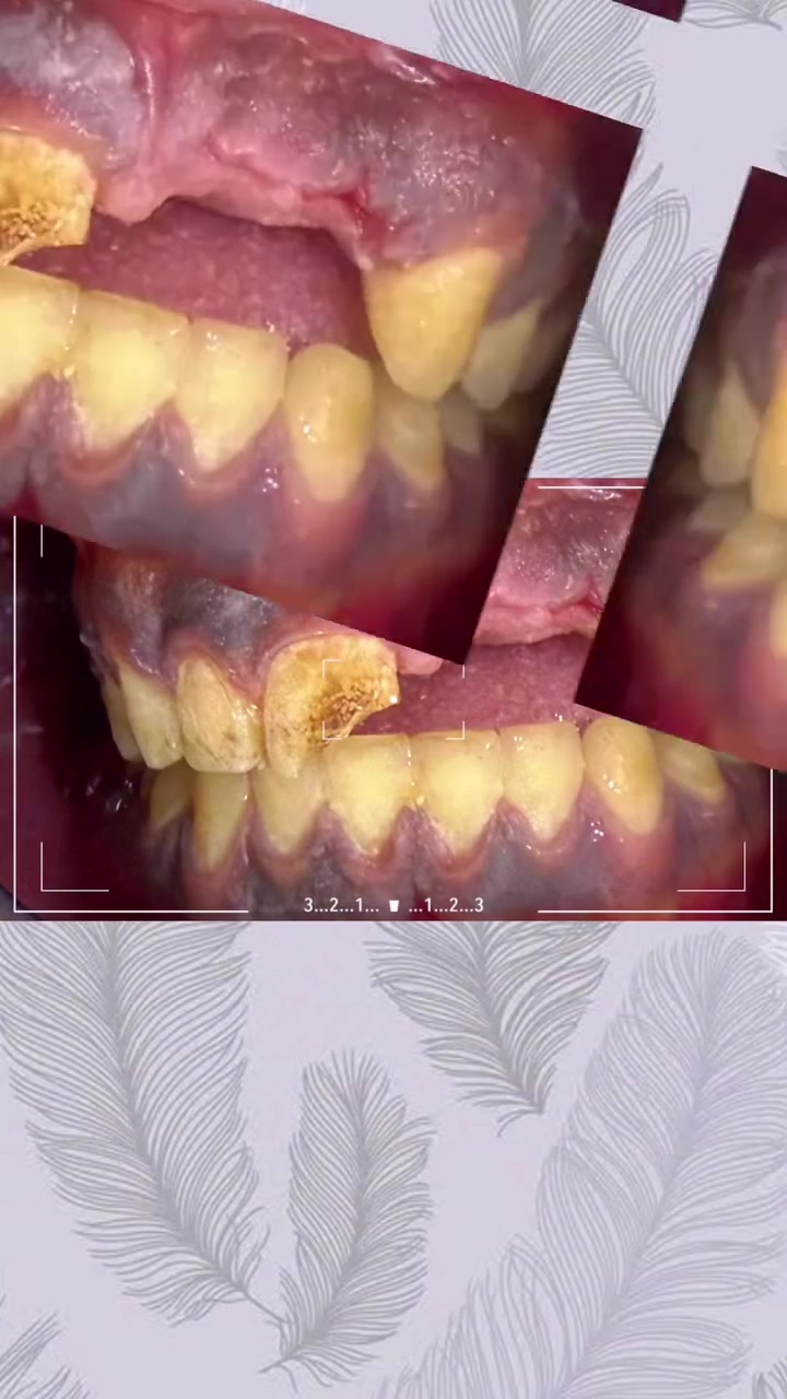 هنا مراجعنا استغل فتره عروض التراكيب وعوض الاسنان المفقودة وحصل على ابتسامة جميلة 
للحجز والاستفسار: ***********
