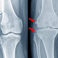 🦵 هل تعاني من ألم أو تشوه في مفصل الركبة؟  تلعب الأشعة الرقمية (DR) دو...