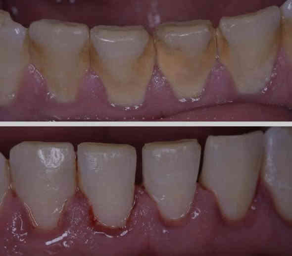 🔴علاج اسنان مجاني وباشراف اطباء اختصاص 
_قلع
_تنظيف اسنان 
_حشوات  ضوئية
_تقويم متحرك
_طقم كامل متحرك
_حشوات اطفال وفلورايد ( ماده تمنع تسوس اسنان الاطفال)
_علاج مشاكل اللثة والتقرحات 
_علاج الام المفصل الصدغي
_اشعة وفحص للاسنان  
📍عيادات جامعة الكوفه خلف كليه الفقه
للحجز والاستفسار: 
@manar_w44 
***********
