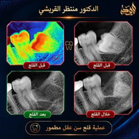 قلع سن العقل • سن العقل المطمور • جراحة الفم • طب الأسنان • عيادة أسنا...