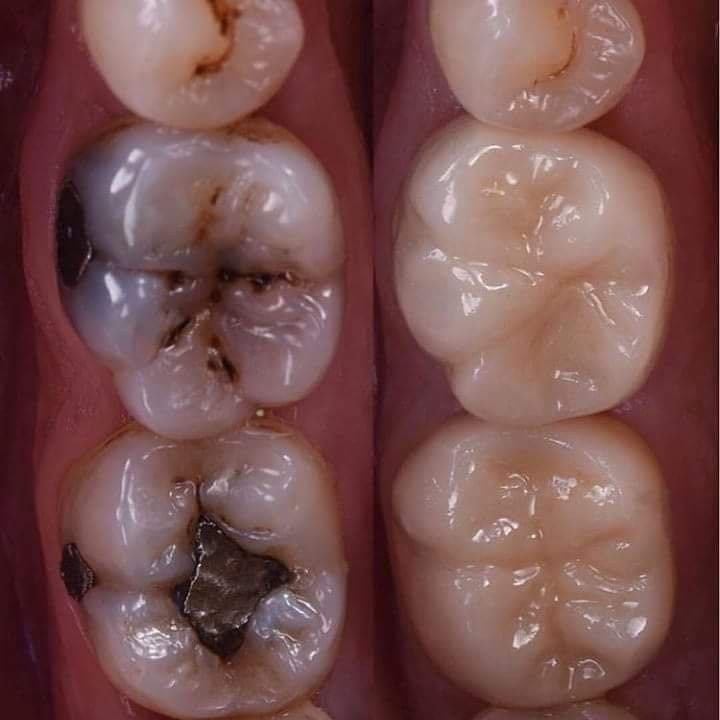 مجانا ……مجانا…..مجانا ‼️‼️

تعلن عيادات الصفوه التخصصيه لطب الاسنان عن استقبالها للمراجعين وبشكل مجاني✅
~~~~~~~~~~~~~~~~~~~~~~~~~~~~~~~~~~~
ليومي 
الاحد من 8:00 صباحا و الى 2:30 مساء
الثلاثاء من 8:00 صباحا و الى 2:30 مساءا
………………………………………………………………………
 ويشمل العلاج 
1-حشوات دائميه ضوئيه و الحشوات التجميليه 
2- قلع الاسنان التالفه و الجذور المتبقيه و تعويضها بطقم اسنان
3- تنظيف الاسنان من التكلسات و التصبغات 
4-معالجه امراض اللثة 
5- فحص الاطفال 
6-تعويض الاسنان المفقوده 
علما إن العلاج ب اشراف اطباء اختصاص ✅
،،،،،،،،،،،،،
⏰ العرض لفترة محدودة – احجز موعدك الآن لتضمن مكانك!
/////////////////////////////////////////
📞 للحجز والاستفسار: واتساب ***********
‏                                              ‭.0777 769 9044‬
📍 العنوان: [كربلاء حي النقيب شارع النهر ]

✨ ابتسامتك تستحق الأفضل… والآن مجانًا! ✨
