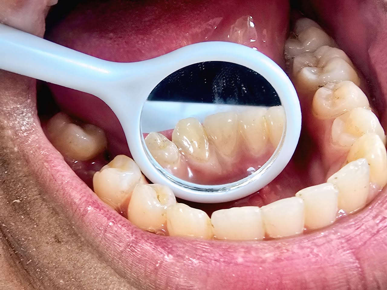 مجاناً🔴🔴 
 ♕حشوات ظوئية تجميلية وازالة التسوس
♕ قلع الاسنان والجذور المتبقية
♕تنظيف الاسنان وإزالة التكلسات الموجودة
♕طقم جزئي متحرك لتعويض الأسنان المفقودة  
للحجز والاستفسار: ***********
كربلاء _السعدية _خلف مول الحارث
